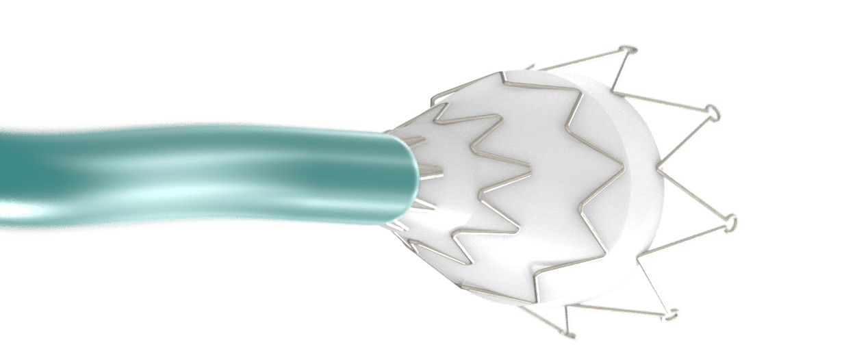 Z-stent delivery system example